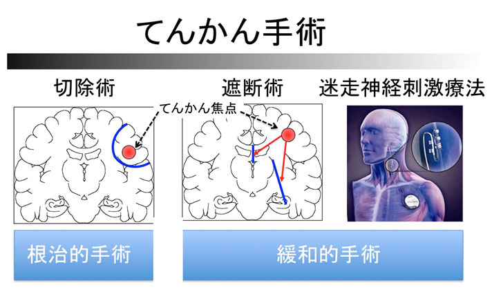 てんかん手術の切除術、遮断術、迷走神経刺激療法説明図