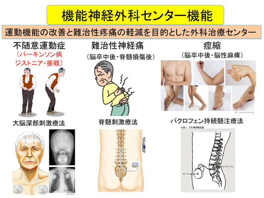 機能神経外科センター機能 説明画像