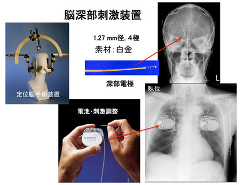 大脳深部刺激療法 説明画像