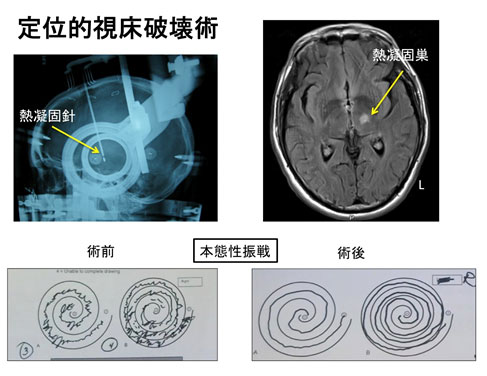 定位的視床破壊術 説明画像