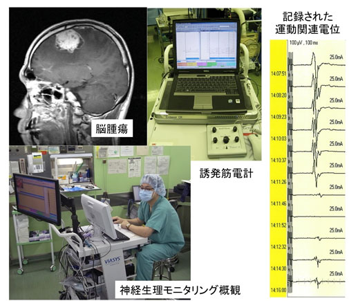 機能神経外科手術 説明画像