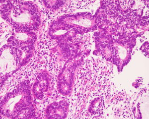 胃がん細胞画像