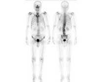 骨シンチ検査で撮影した全身骨正面像と背面像の画像