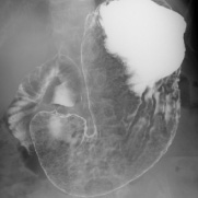 MDL(胃透視検査) 画像