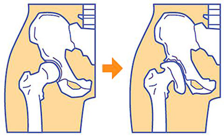 変形性股関節症発症前後の比較イラスト