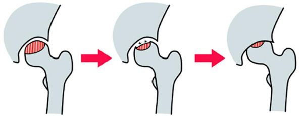 特発性大腿骨頭壊死症の病状進行の説明イラスト