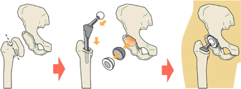人工股関節（前方進入法）の説明イラスト