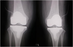 手術後の変形性膝関節症（両側同時人工膝関節置換術）レントゲン写真