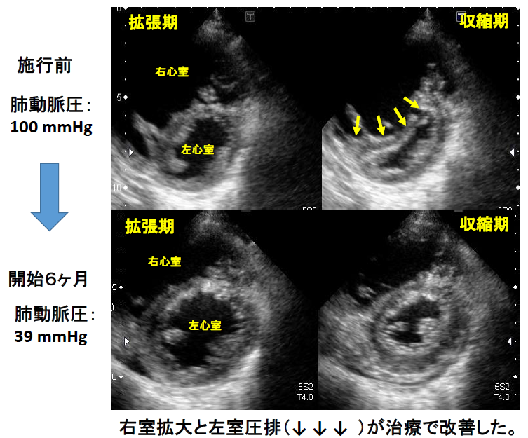 持続的PGI2作動薬静注療法の効果説明写真