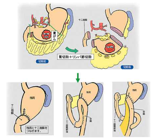 胃がんにおける通常の手術療法の説明イラスト