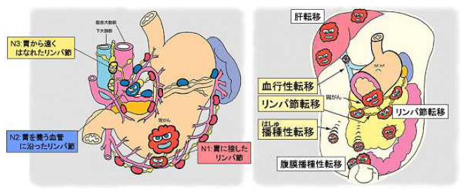 胃がん進行度（血行性転移、リンパ節転移、播種性転移）説明イラスト