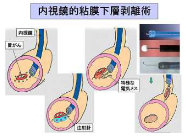 内視鏡的粘膜下層剥離術の説明イラスト