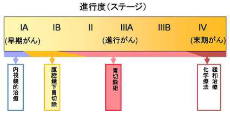 胃がん進行度（ステージ）による治療内容の違いの説明図