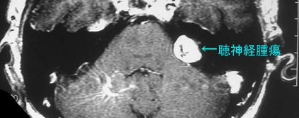 聴神経腫瘍のレントゲン写真