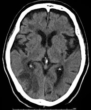 ラジオサージャリー実施前のレントゲン写真（脳部分）