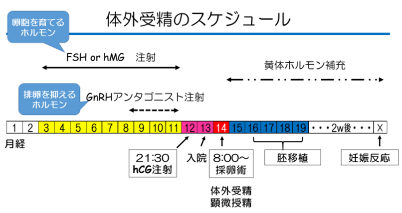 体外受精スケジュールのイメージ画像（FSH or hMG注射、GnRHアンタゴニスト注射、黄体ホルモン補充等のタイミング）