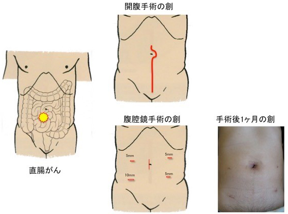 直腸がん手術の創の違いの説明イラスト