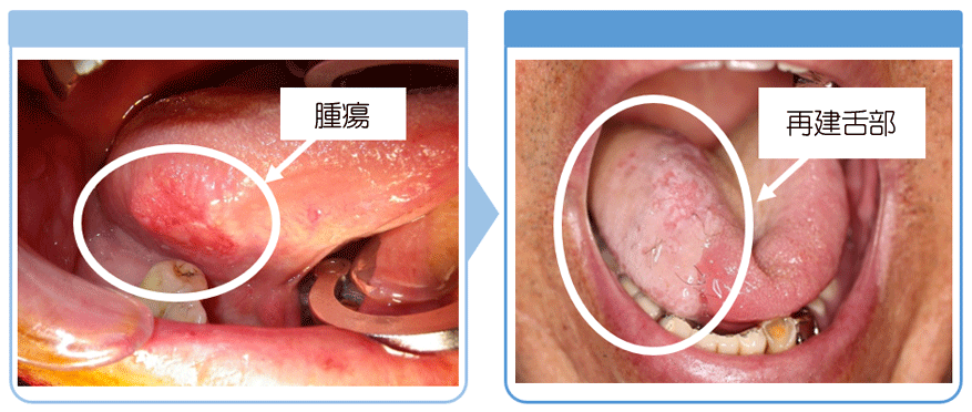 再建舌部