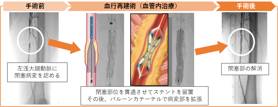 血行再建術