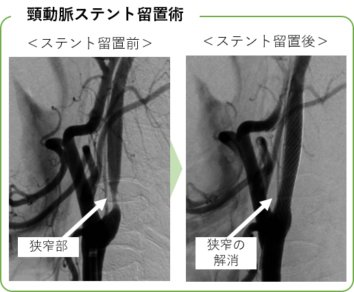 頸動脈ステント留置術