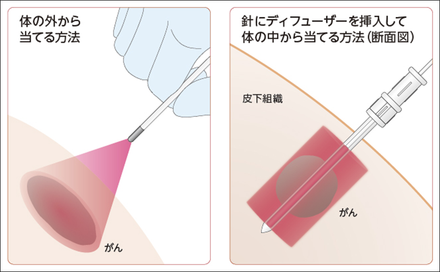 頭頸部癌への光免疫療法