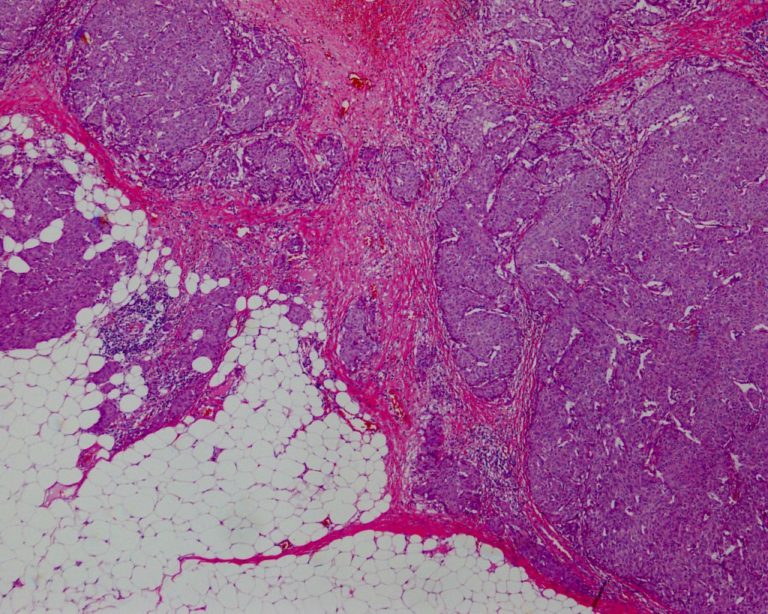 乳癌(充実腺管癌)