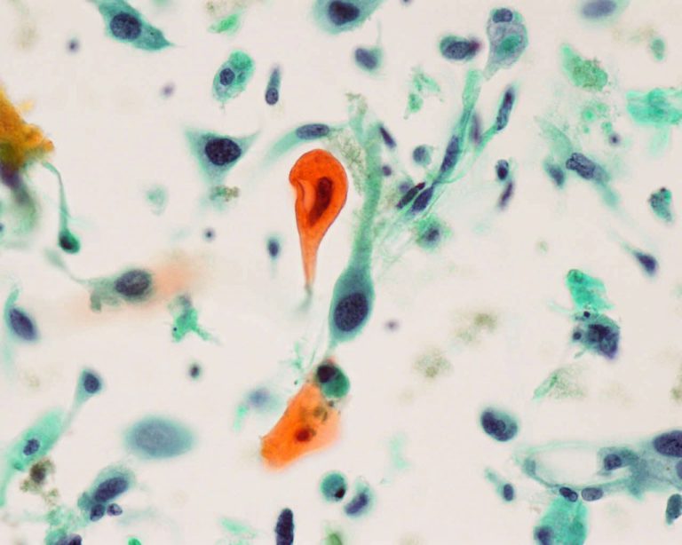 子宮頸部細胞診 角化型扁平上皮癌