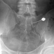 神経根ブロック 画像