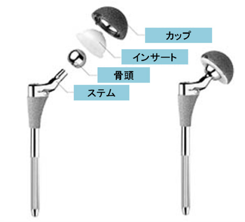 人工股関節部品の説明（カップ、インサート、骨頭、ステム）