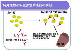 特発性血小板減少性紫斑病(ITP)説明画像