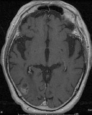 ラジオサージャリー実施後のレントゲン写真（脳部分その２）
