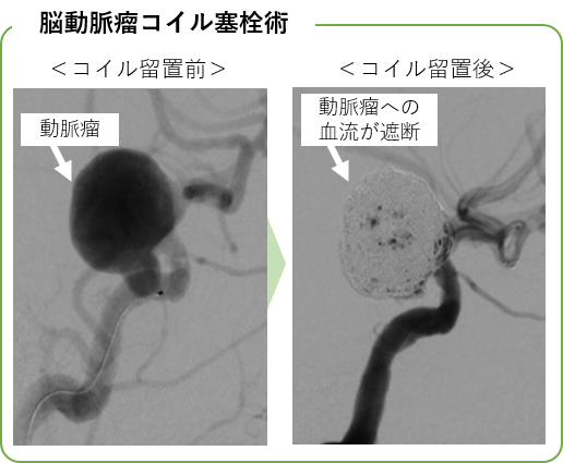 脳動脈瘤コイル塞栓術