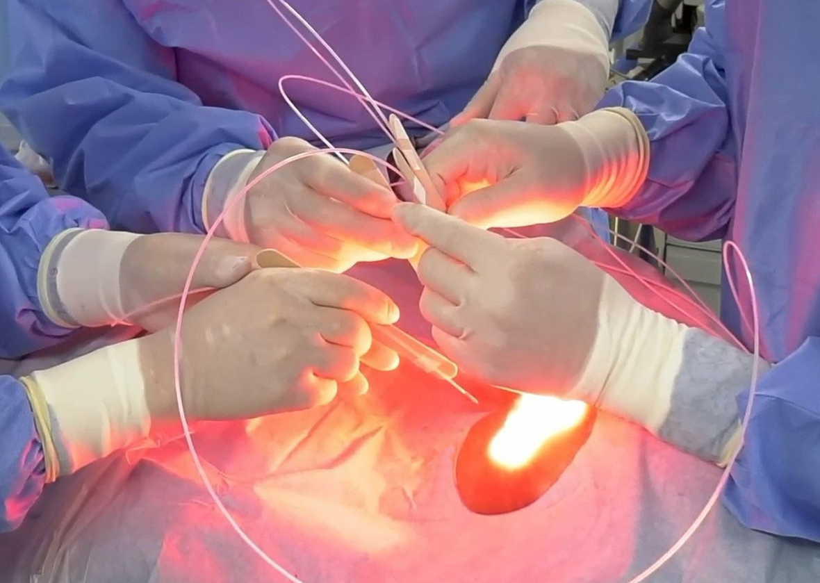 頭頸部癌への光免疫療法