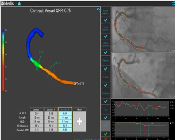 QFR(定量的血流量比較解析)
