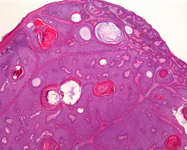 皮膚生検組織診　良性皮膚腫瘍
