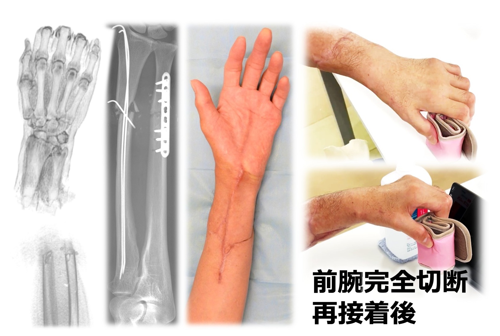 前腕完全切断、再接着後